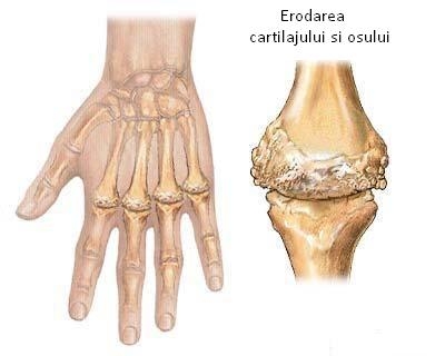 Artrita reumatoida: tratament